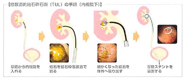 経尿道的尿路結石破砕術の手順